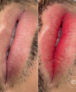 Lip Revitalization